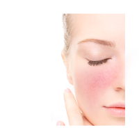 ROSACEA